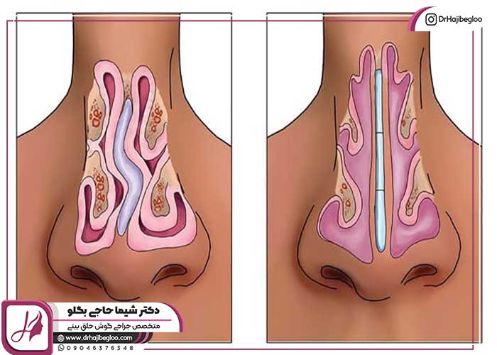 هزینه عمل بینی پهن و گوشتی 1404